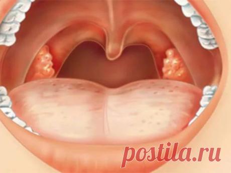 Как лечить тонзиллит?