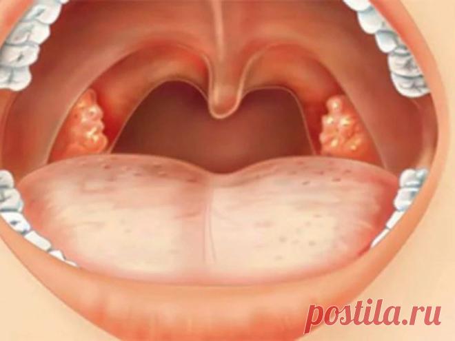 Как лечить тонзиллит?