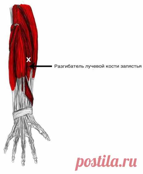 Cиндром запястного канала. Триггерные точки