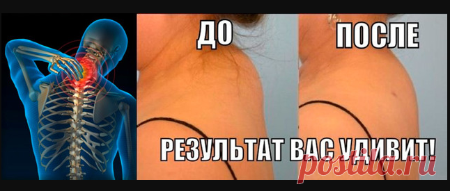 Вдовий горб как избавиться?