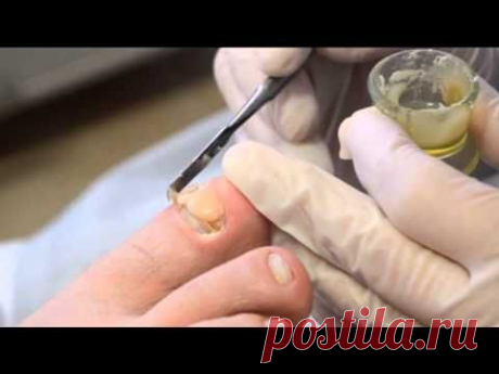 Онихомикоз: обработка ногтя. Эфир Periscope / Onychomycosis. Nail treatment - YouTube