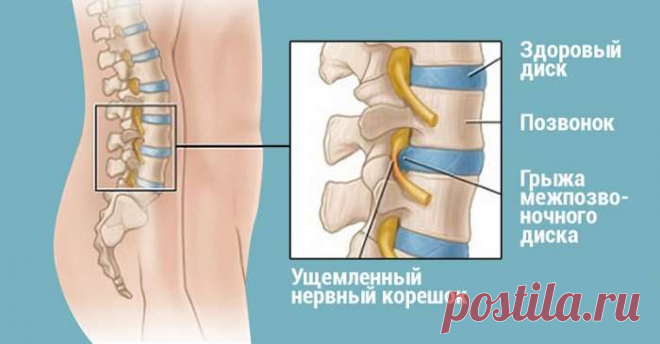Хирург отговорил дядю от операции, посоветовав делать ЭТИ упражнения… Спустя полгода результат! — СОВЕТНИК