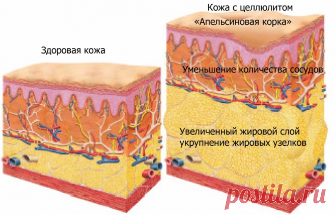 Целлюлит: массаж в домашних условиях, комплекс упражнений и обертывания
Если возник целлюлит, массаж в домашних условиях может исправить проблему, но ведущую роль играют упражнения. Целлюлит – это не накопленные токсины или застоявшаяся кровь, это просто жировые отложения, в результате из-за особенностей строения жировой ткани у женщин кожа выглядит бугристой.
Целлюлит появляется без какой-либо причины, и с возрастом шанс получить апельсиновую корку увеличивается. Соединит...