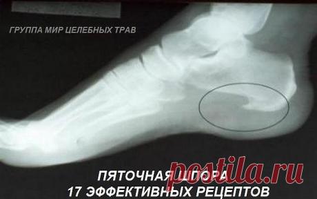 Пяточная шпора: 17 эффективных рецептов народной медицины

Пяточные шпоры - костные разрастания в виде шипа или клюва на подошве у пяточной кости или у места прикрепления ахиллова сухожилия. Лечение пяточных шпор процесс длительный. Избыточный вес, заболевания позвоночника и крупных суставов нижних конечностей, плоскостопие - все это может спровоцировать появление пяточной шпоры.

Лечение пяточной шпоры, наростов народными средствами:

Картофель от шпор на ногах.

Сварите ...