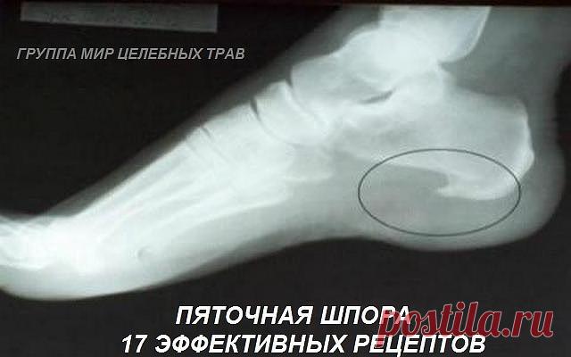 Пяточная шпора: 17 эффективных рецептов народной медицины

Пяточные шпоры - костные разрастания в виде шипа или клюва на подошве у пяточной кости или у места прикрепления ахиллова сухожилия. Лечение пяточных шпор процесс длительный. Избыточный вес, заболевания позвоночника и крупных суставов нижних конечностей, плоскостопие - все это может спровоцировать появление пяточной шпоры.

Лечение пяточной шпоры, наростов народными средствами:

Картофель от шпор на ногах.

Сварите ...