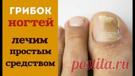 Это простое 2-компонентное средство навсегда избавит вас от грибка ногтей