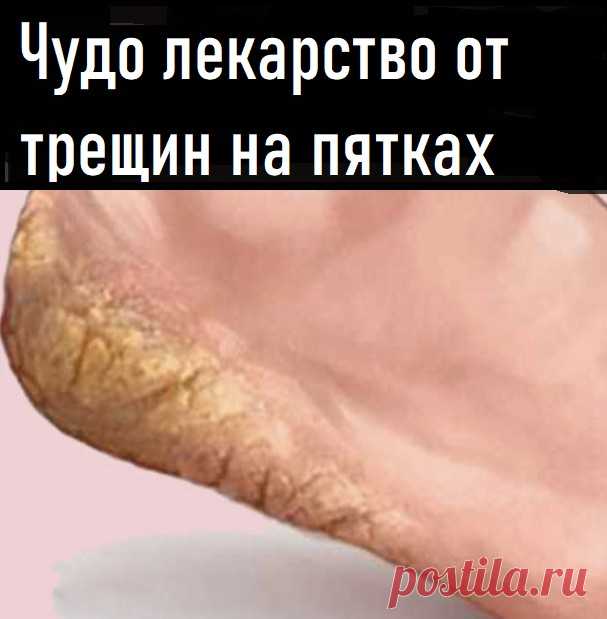 ● 10 таблеток аспирина
● 250 мл 70%-го спирта

1. Растолки таблетки в порошок и залей их спиртом. Смесь должна постоять несколько дней.

2. Перед каждым применением взбалтывай емкость со смесью. Затем смочи ватный тампон в растворе и положи его к проблемному месту.
Заверни пятку полиэтиленовой пленкой и оставь на ночь.

3. Утром помой ноги, насухо вытри их полотенцем и нанеси на них глицерин или жирный крем.

4. Трещины на пятках и огрубевшая кожа исчезнут уже после десяти дней.