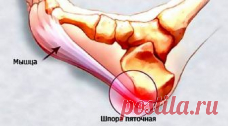 - Шпора на пятке - Как лечить пяточную шпору в домашних условиях -