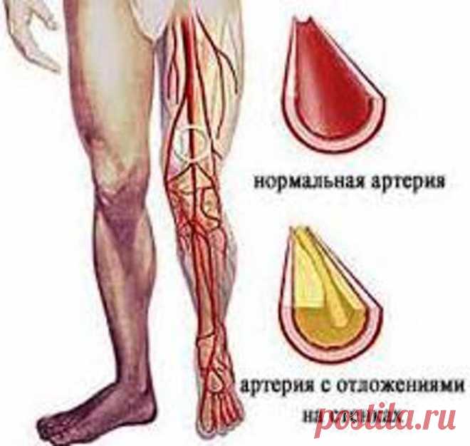 Лечение атеросклероза сосудов ног.