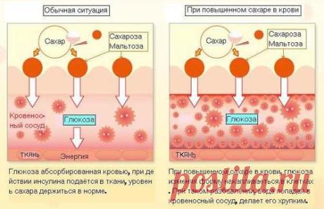Как снизить сахар в крови в домашних условиях: быстро и эффективно