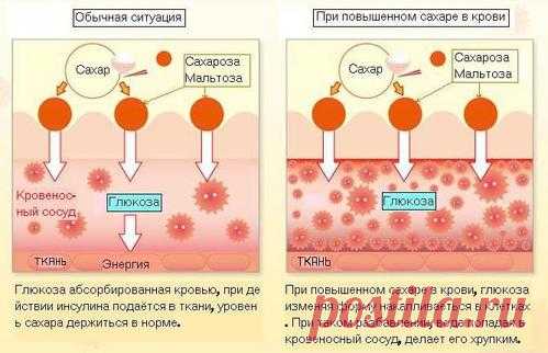 Как снизить сахар в крови в домашних условиях: быстро и эффективно