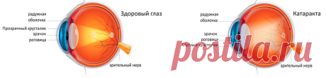 Глаукома и катаракта, в чем разница? | Зеркало Души | Яндекс Дзен