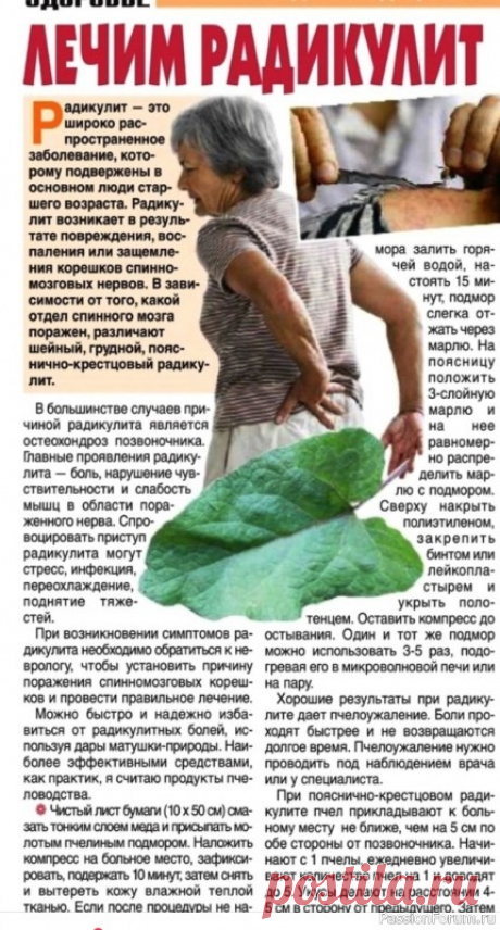 Лечение радикулита народными средствами  .