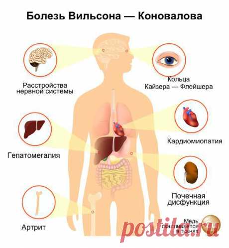 Болезнь Вильсона — Коновалова: причины, симптомы и лечение в статье невролога Толмачев А. Ю.