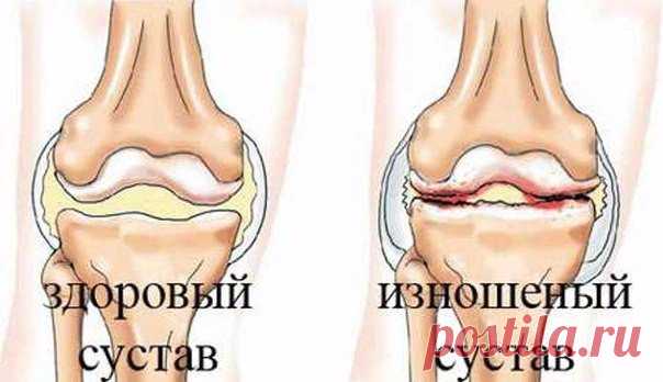 Запись на стене Отличный рецепт от боли в суставахПростейший народный рецепт для лечения суставов.(не смотрите, что простой, очень много отзывов об эффективности этого рецепта!)Наверняка многие не по наслышке знают, что такое боли в суставах. Какой, мягко скажем, дискомфорт доставляют они чел..