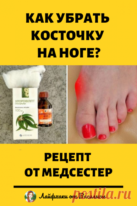 Как убрать косточку на ноге. Рецепт от медсестер. Красота и здоровье в домашних условиях