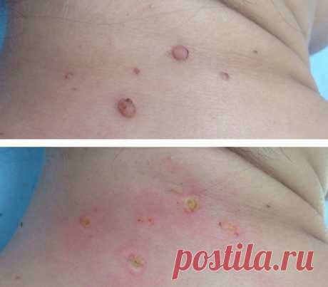 Аллокин-альфа при ВПЧ: цена, инструкция, отзывы