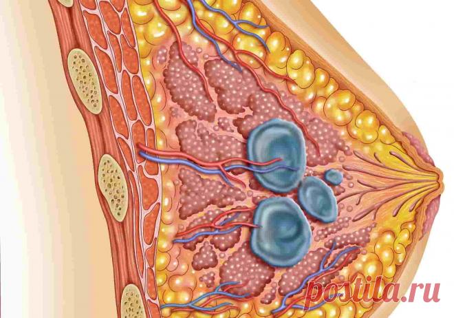 Галактоцеле  (код МКБ-10; код МКБ-11): описание, причины, симптомы, как лечить | Клиника лечения боли: врачи онлайн