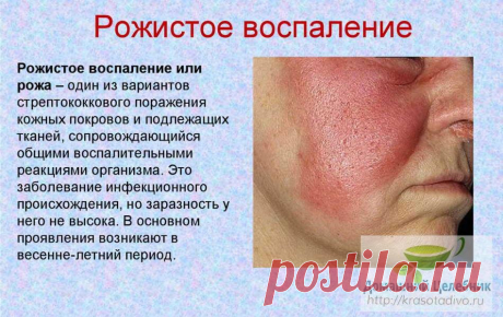 Рожа: болезнь пожилых женщин и молодых мужчин. Народные методы лечения Рожа — инфекционная болезнь, вызываемая гемолитическим стрептококком. Внешне она проявляется воспалением кожи в виде красного пятна, что прогрессирует.

В структуре инфекционной патологии это заболева…
