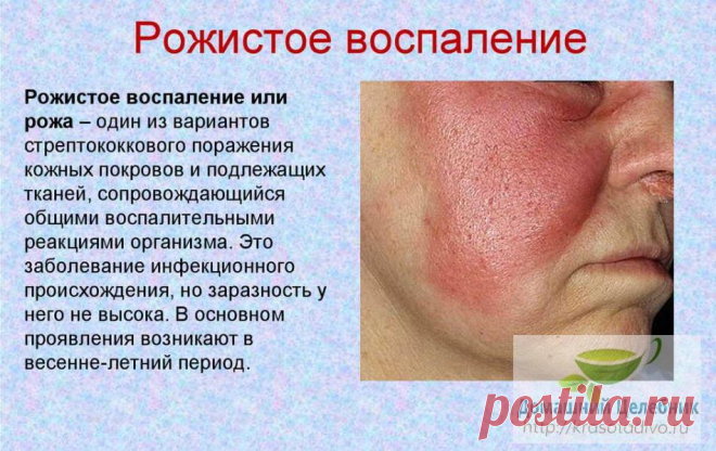 Рожа: болезнь пожилых женщин и молодых мужчин. Народные методы лечения Рожа — инфекционная болезнь, вызываемая гемолитическим стрептококком. Внешне она проявляется воспалением кожи в виде красного пятна, что прогрессирует.

В структуре инфекционной патологии это заболева…
