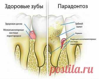 Пародонтоз: симптомы и лечение в домашних условиях | Азбука здоровья