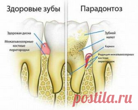 Пародонтоз: симптомы и лечение в домашних условиях | Азбука здоровья