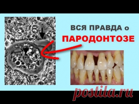 ВСЯ ПРАВДА О ПАРОДОНТОЗЕ . Почему НА САМОМ ДЕЛЕ образуется пародонтоз .