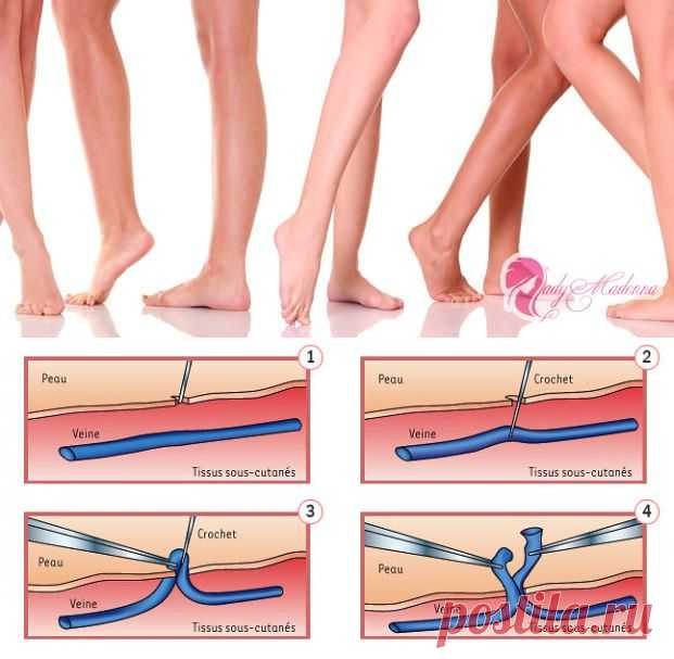 Неоперативные методы лечения варикозной болезни