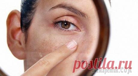 Возрастные пятна – причины и способы устранения