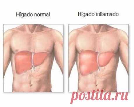 Hígado inflamado: síntomas y dieta adecuada - Mejor Con Salud