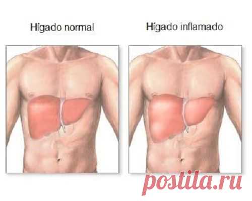 Hígado inflamado: síntomas y dieta adecuada - Mejor Con Salud