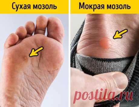 11 легких способов вылечить мозоль от неудобной обуви