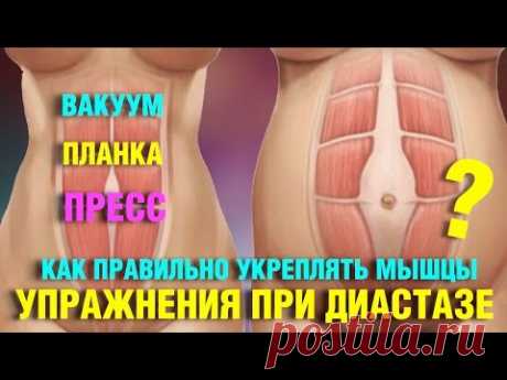 Диастаз. Упражнения при расхождении белой линии живота. Лечение диастаза