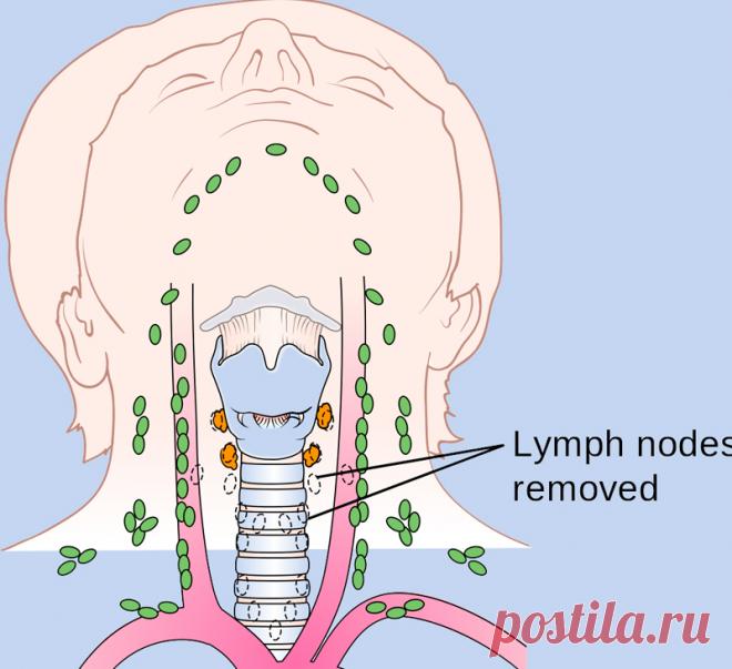 Если отеки не проходят, копайте глубже: психосоматика застоя лимфы Отеки возникают вследствие задержки в организме жидкости, размер органов и частей тела увеличивается, что затрудняет передвижение и доставляет массу неудобств. Иногда отеки настолько большие, что человеку не просто трудно одеться и обуться, но и сложно передвигаться. В самых запущенных ситуациях кожа краснеет и покрывается мелкими трещинами, из которых сочится жидкость. В мелкие раны может легко проникнуть ...