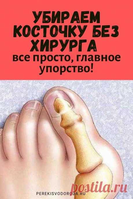 Убираем косточку без хирурга: все просто, главное упорство!