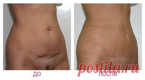Пластика лобка: у мужчин, у женщин, показания, противопоказания, липосакция лобка, реабилитация