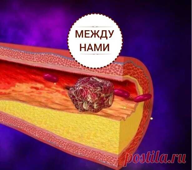 Какие напитки способствуют рассасыванию тромбов? (часть 2) | Между нами | Яндекс Дзен