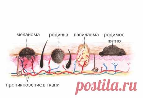 Дневник Montileda : Как отличить родинку от папилломы