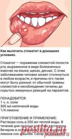 СТОМАТИТ
