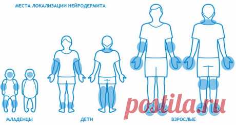 Все о нейродермите: причины, виды и профилактика заболевания