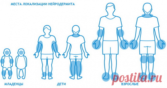 Все о нейродермите: причины, виды и профилактика заболевания