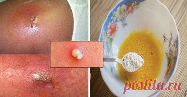Домашнее средство, которое вытащит гной из ран и язв! Эффективно!