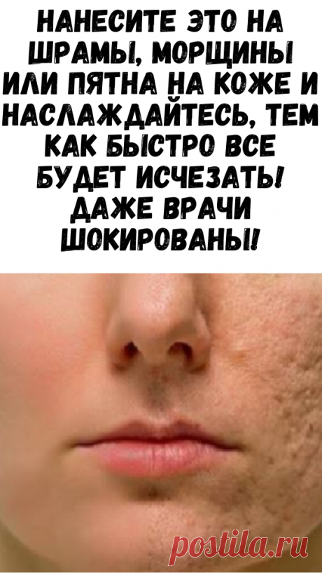 Нанесите это на шрамы, морщины или пятна на коже и наслаждайтесь, тем как быстро все будет исчезать! Даже врачи шокированы! - Советы и Рецепты