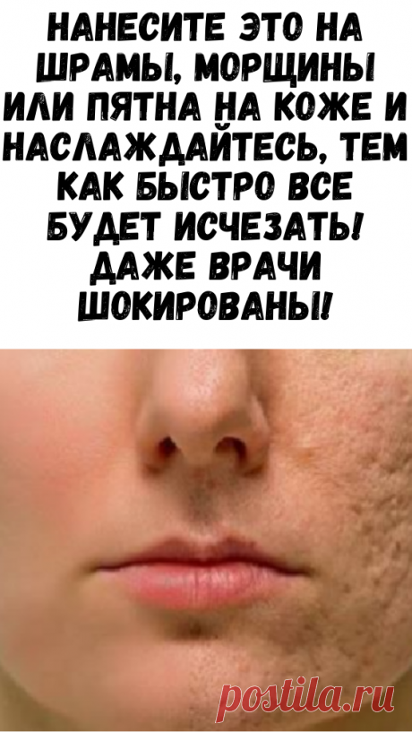 Нанесите это на шрамы, морщины или пятна на коже и наслаждайтесь, тем как быстро все будет исчезать! Даже врачи шокированы! Все мечтают о светлой и чистой коже. Существует множество продуктов и методов лечения, которые часто не работают. Тем не менее, вместо этого, вы можете