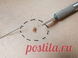 Меланома: взвесим риски! | Я ЗДОРОВ!