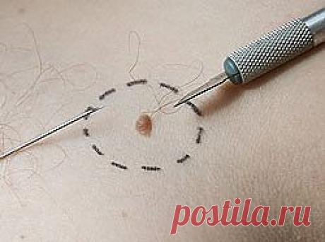 Меланома: взвесим риски! | Я ЗДОРОВ!