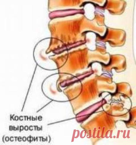 Остеофиты. Причины, симптомы, диагностика и лечение патологии :: Polismed.com