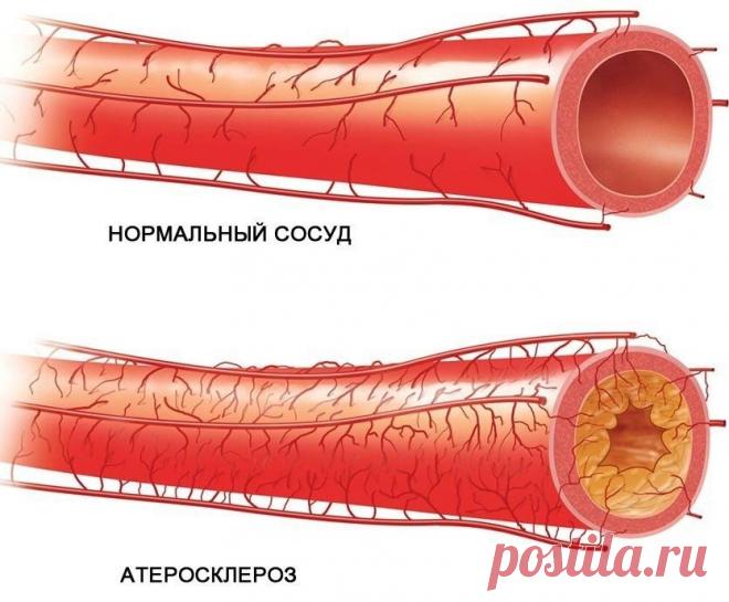Как укрепить сосуды?