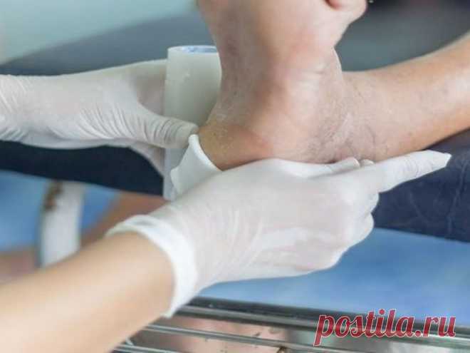 Натуральные методы лечения диабетической стопы