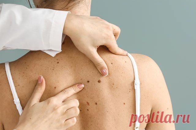 Какие родинки должны насторожить / Будьте здоровы